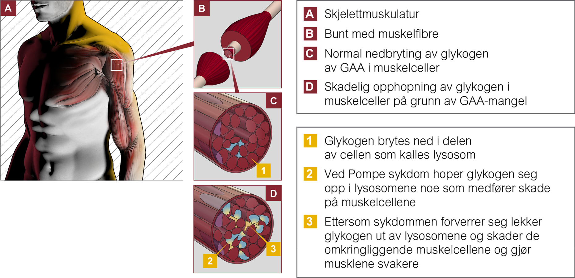 Illustrasjon av Pompes effekt på glykogen i cellene